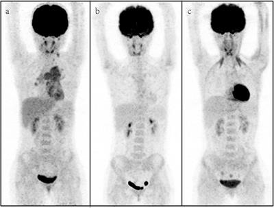 Utility of [18F] Fluoro-Deoxyglucose Positron Emission Tomography/Computed Tomography for Staging and Therapy Response Evaluation in Pediatric Rhabdomyosarcoma: A Case Series and Literature Review